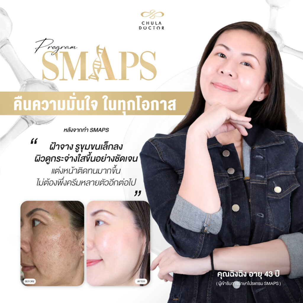 รีวิว รักษาฝ้า