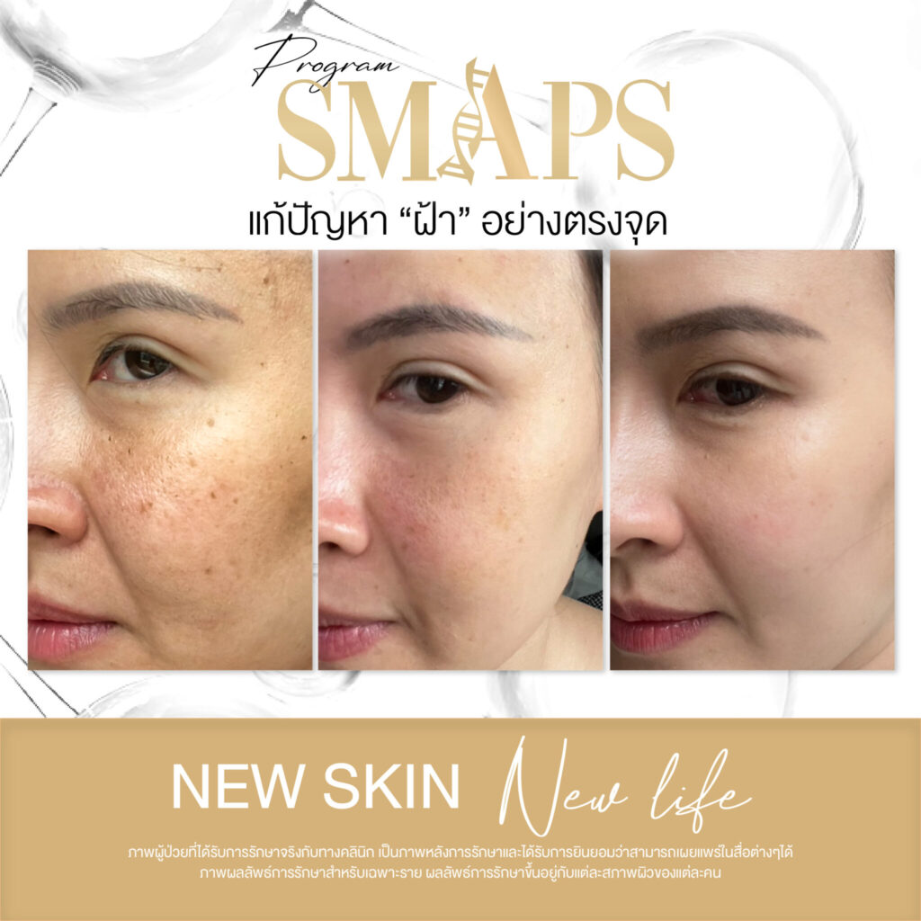 แก้ปัญหา ฝ้า อย่างตรงจุด 10