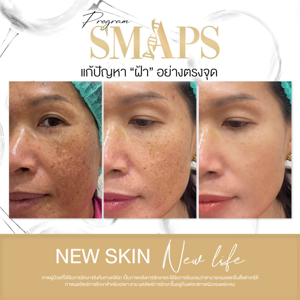 แก้ปัญหา ฝ้า อย่างตรงจุด 12