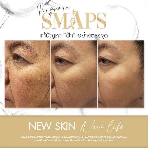 แก้ปัญหา ฝ้า อย่างตรงจุด 14