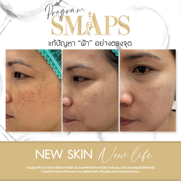 แก้ปัญหา ฝ้า อย่างตรงจุด 17