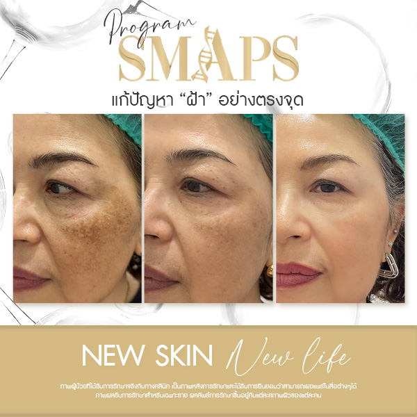 แก้ปัญหา ฝ้า อย่างตรงจุด 19