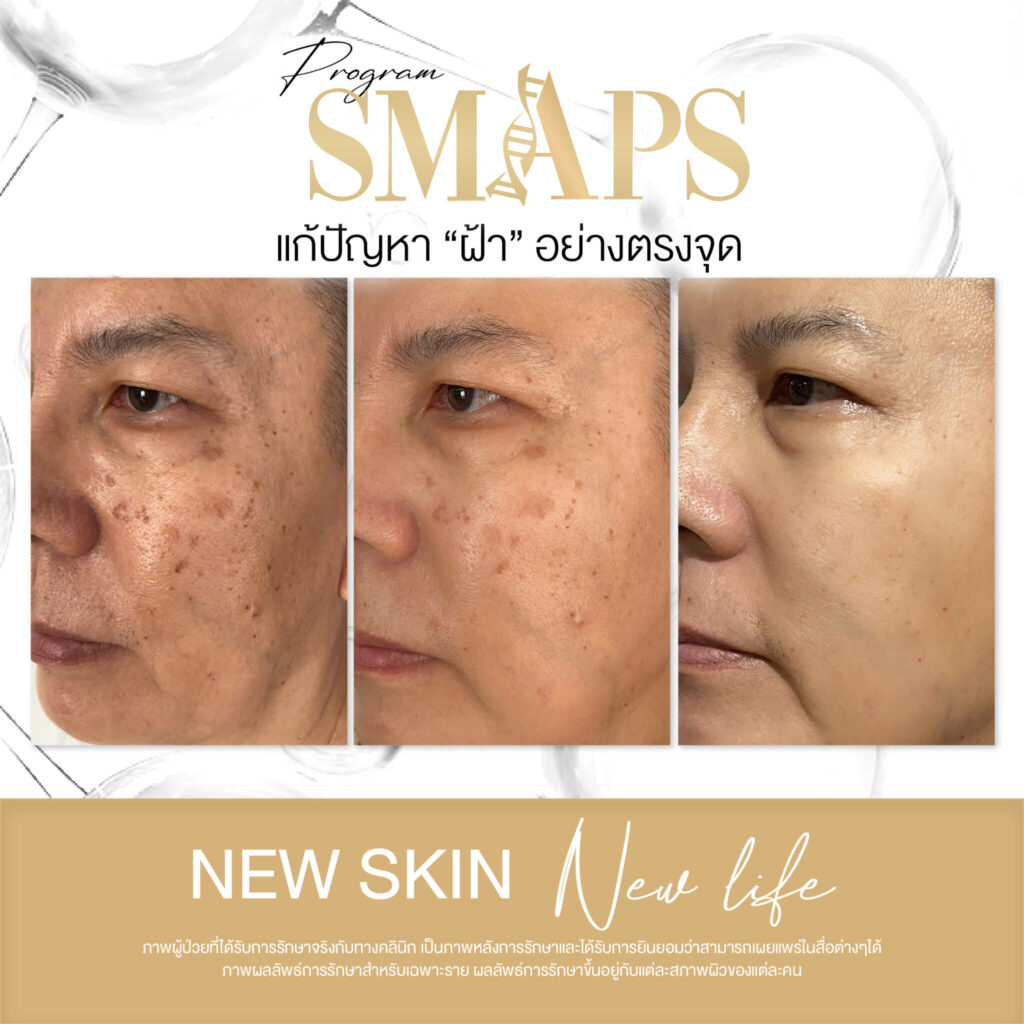 แก้ปัญหา ฝ้า อย่างตรงจุด 3