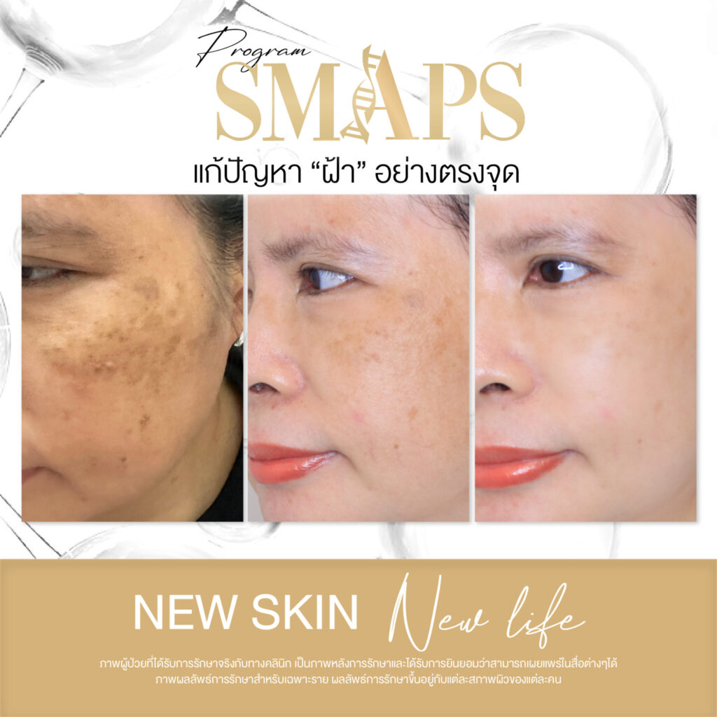 แก้ปัญหา ฝ้า อย่างตรงจุด 6