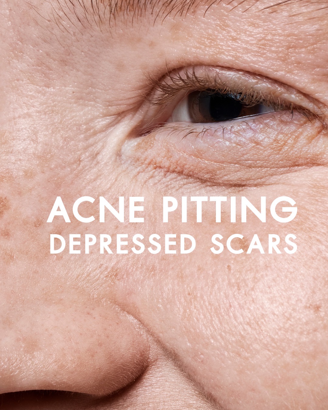 Acne Pitting / Depressed Scars