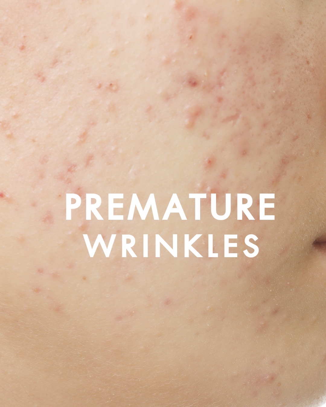 Premature Wrinkles