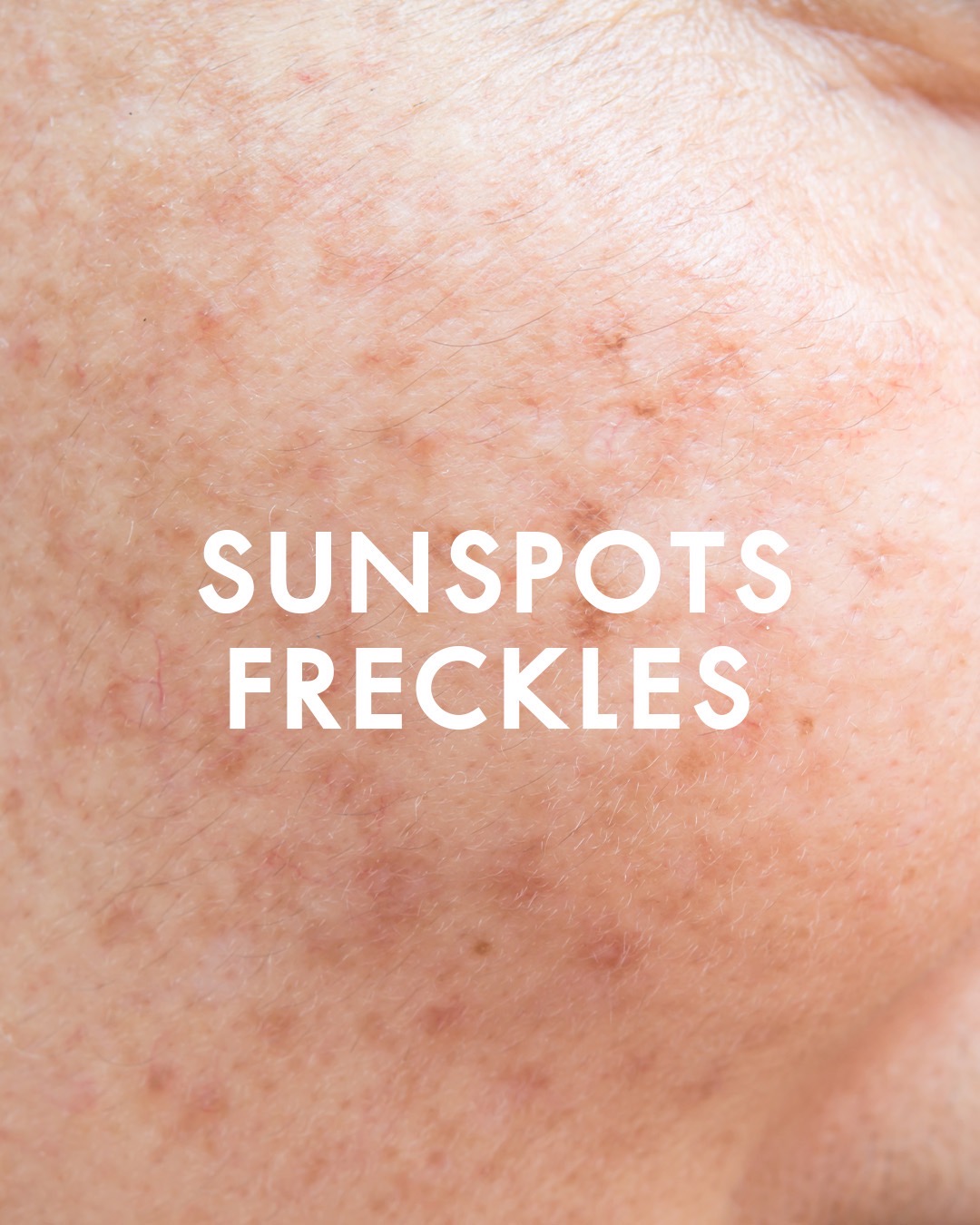 Sunspots / Freckles