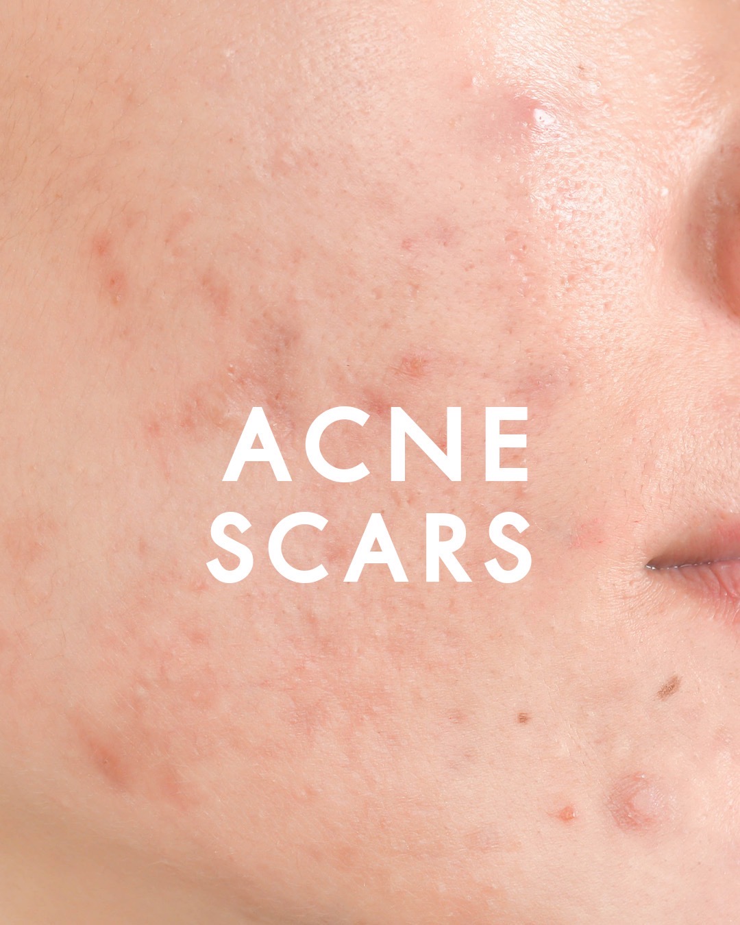 acne scars