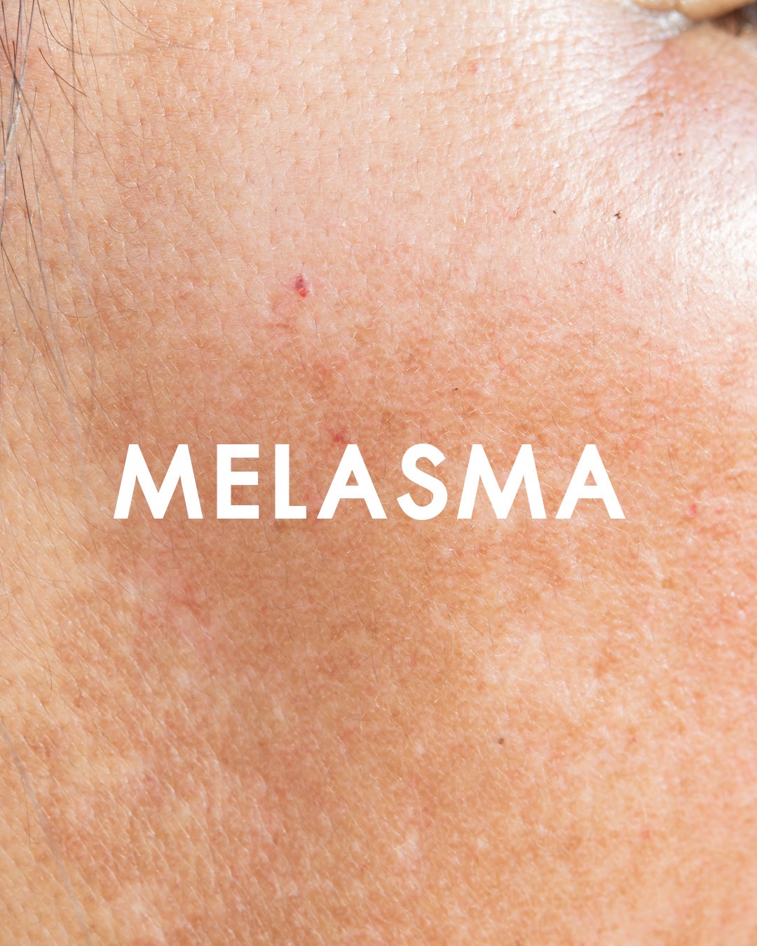 melasma
