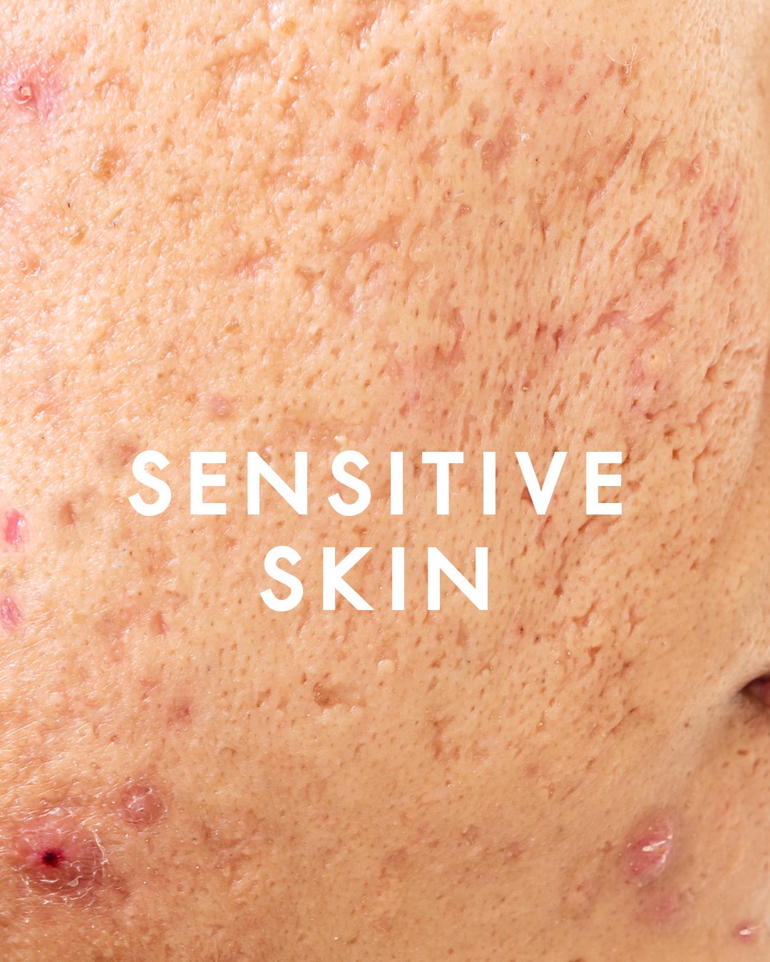 sensitive skin