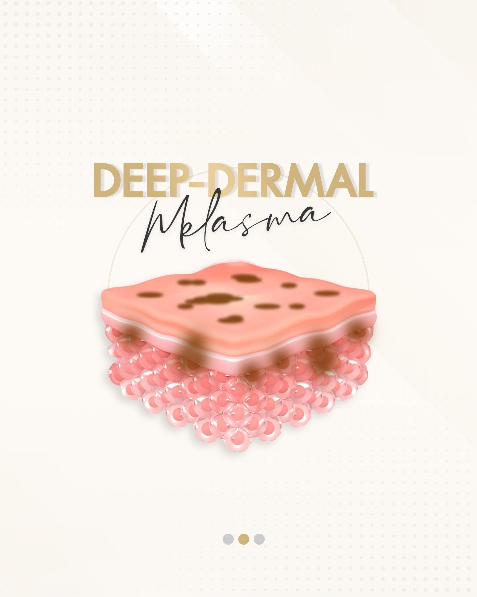 Deep-Dermal Melasma