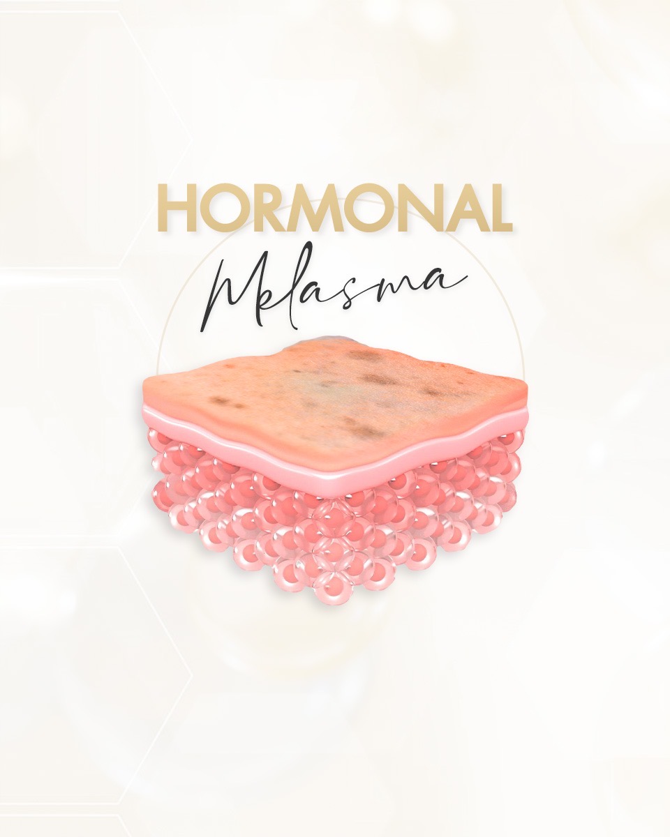 Hormonal Melasma