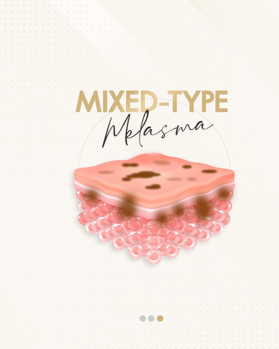 Mixed-Type Melasma