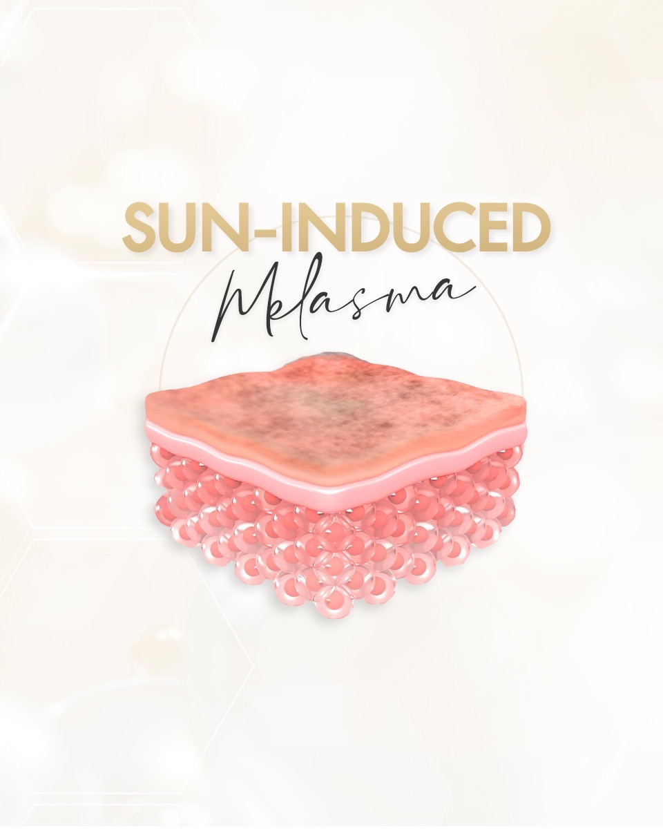 Sun-Induced Melasma