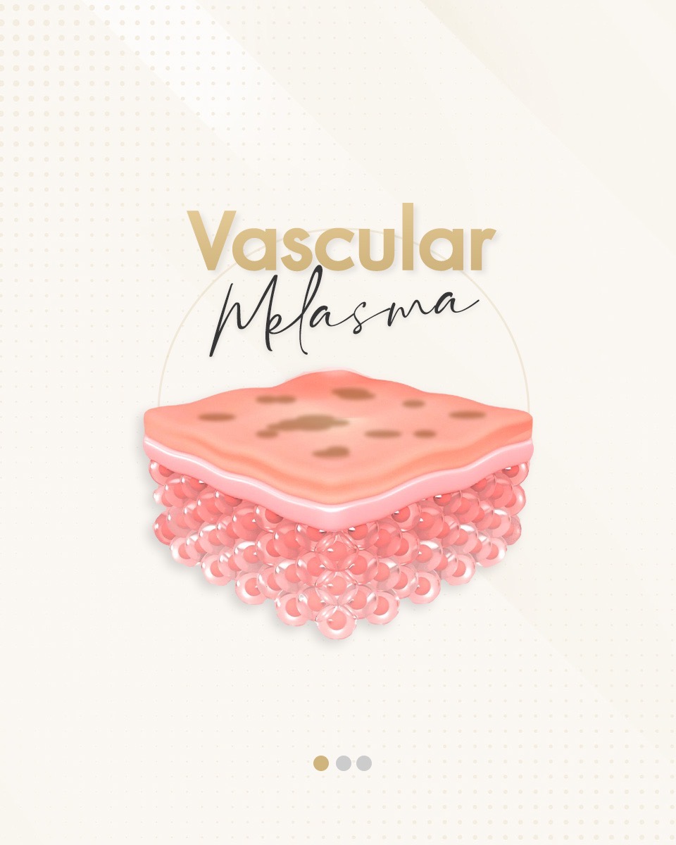 Vascular Melasma