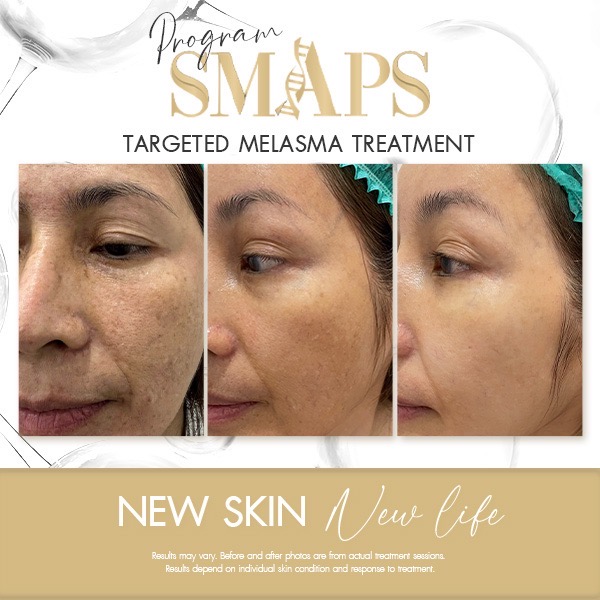 แก้ปัญหา ฝ้า อย่างตรงจุด 20