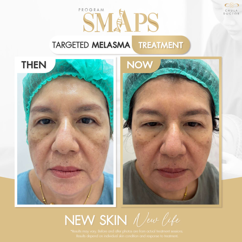 รีวิว before after-2