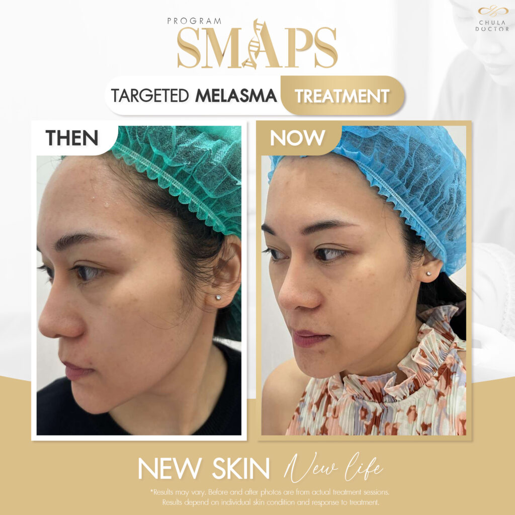 before after รักษาฝ้า 3